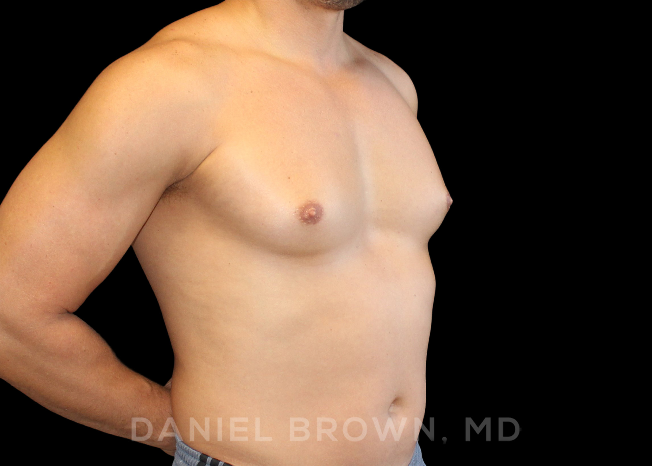 Male Breast Reduction Patient Photo - Case 2658 - before view-2
