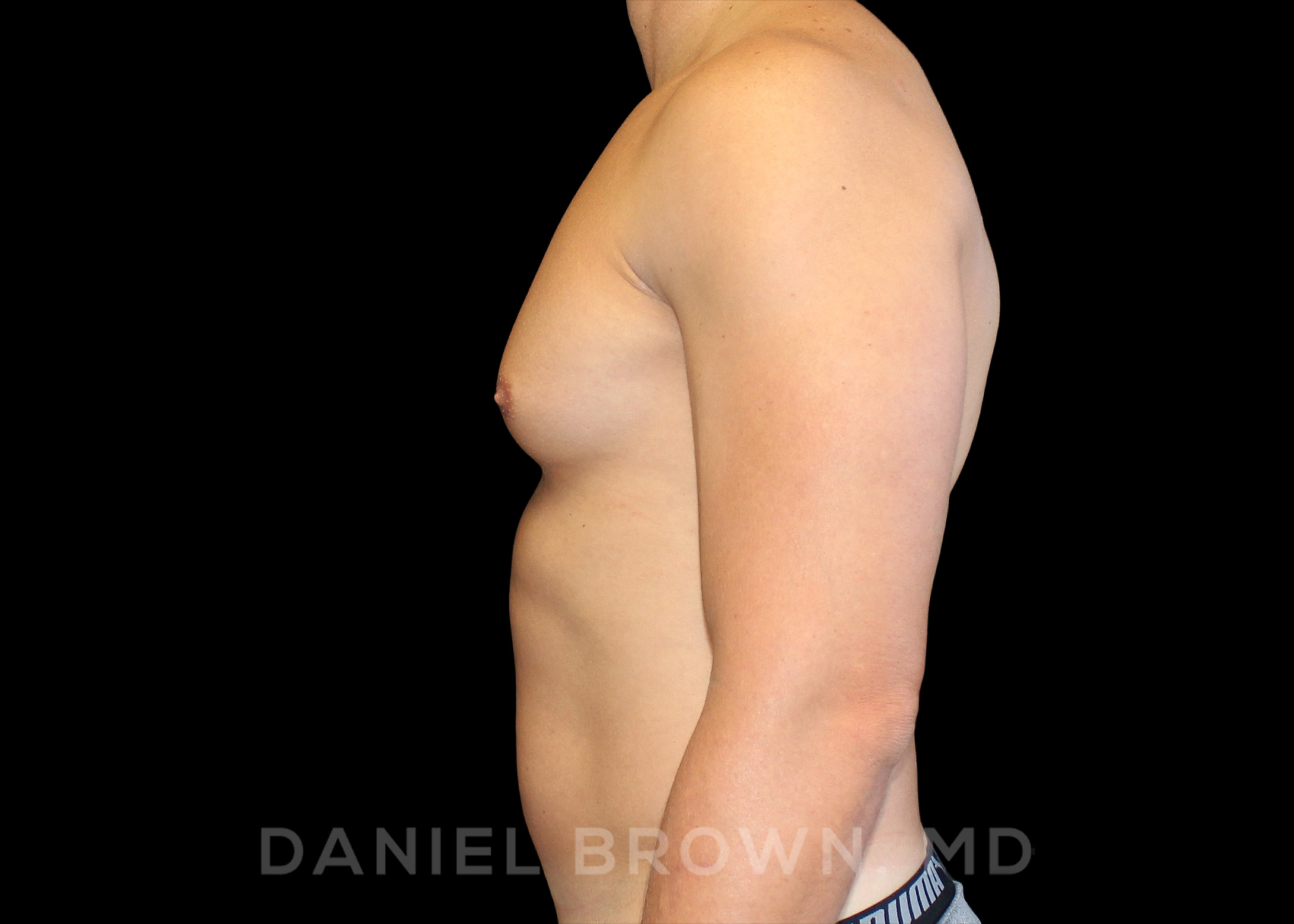 Male Breast Reduction Patient Photo - Case 2658 - before view-3