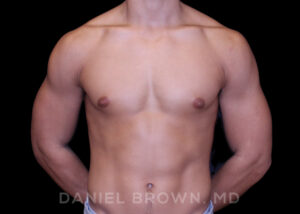Male Breast Reduction - Case 2669 - Before