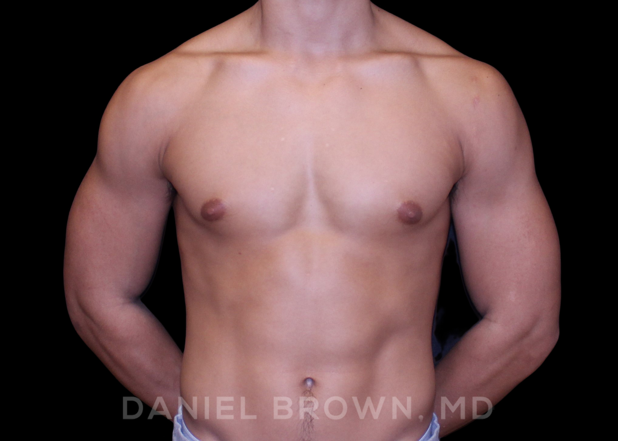 Male Breast Reduction Patient Photo - Case 2669 - before view-