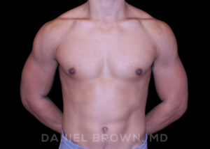Male Breast Reduction - Case 2669 - After