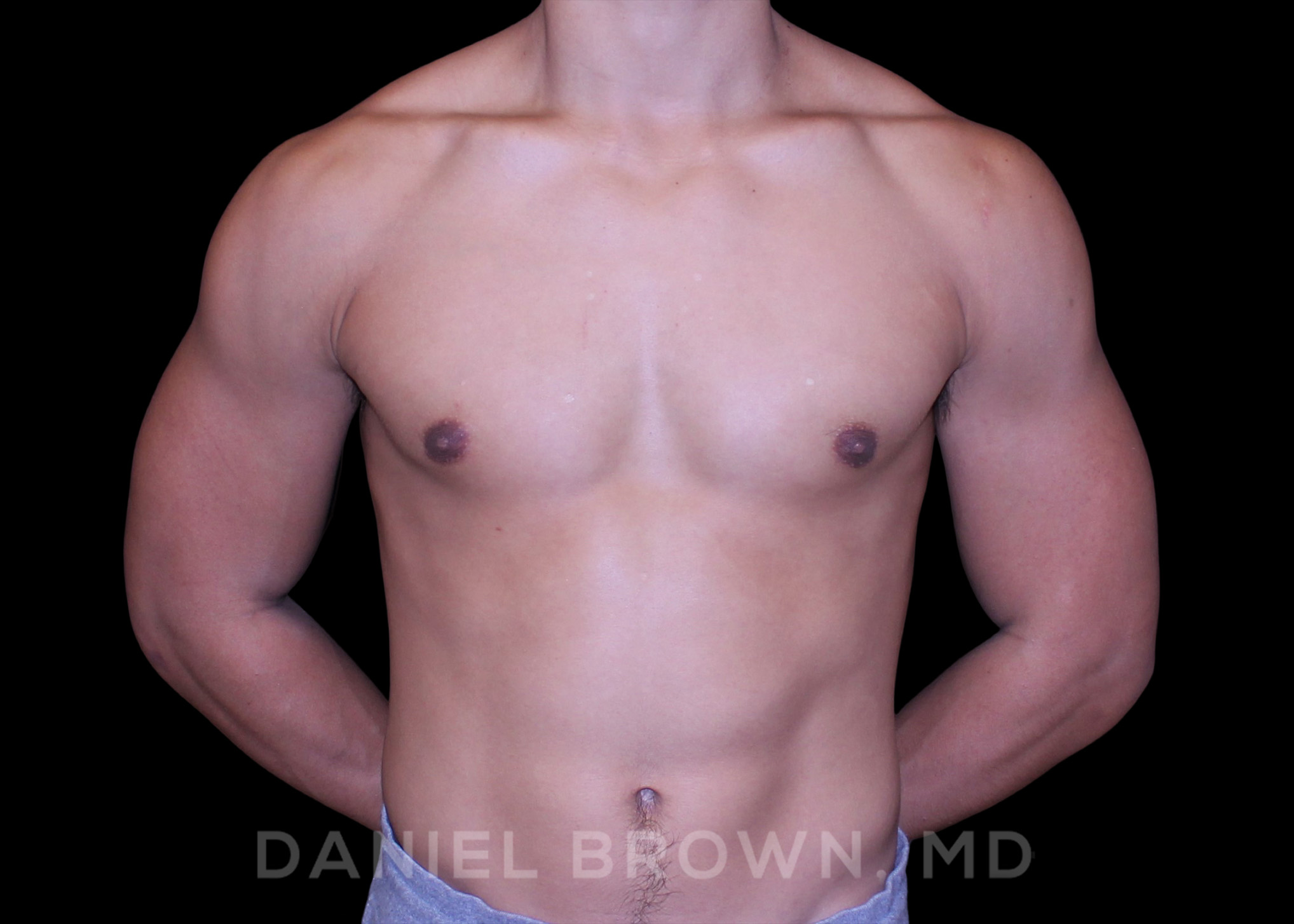 Male Breast Reduction Patient Photo - Case 2669 - after view-0