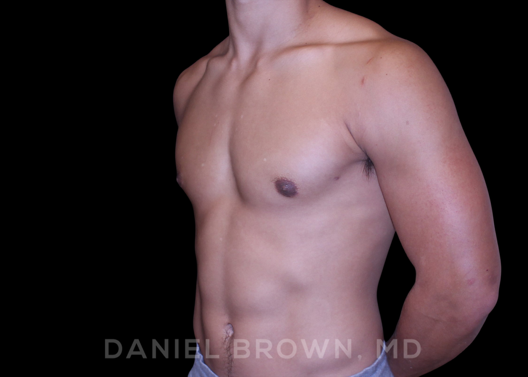 Male Breast Reduction Patient Photo - Case 2669 - after view-1