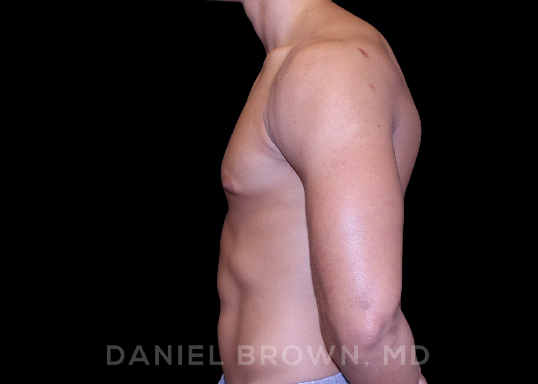 Male Breast Reduction Patient Photo - Case 2669 - before view-