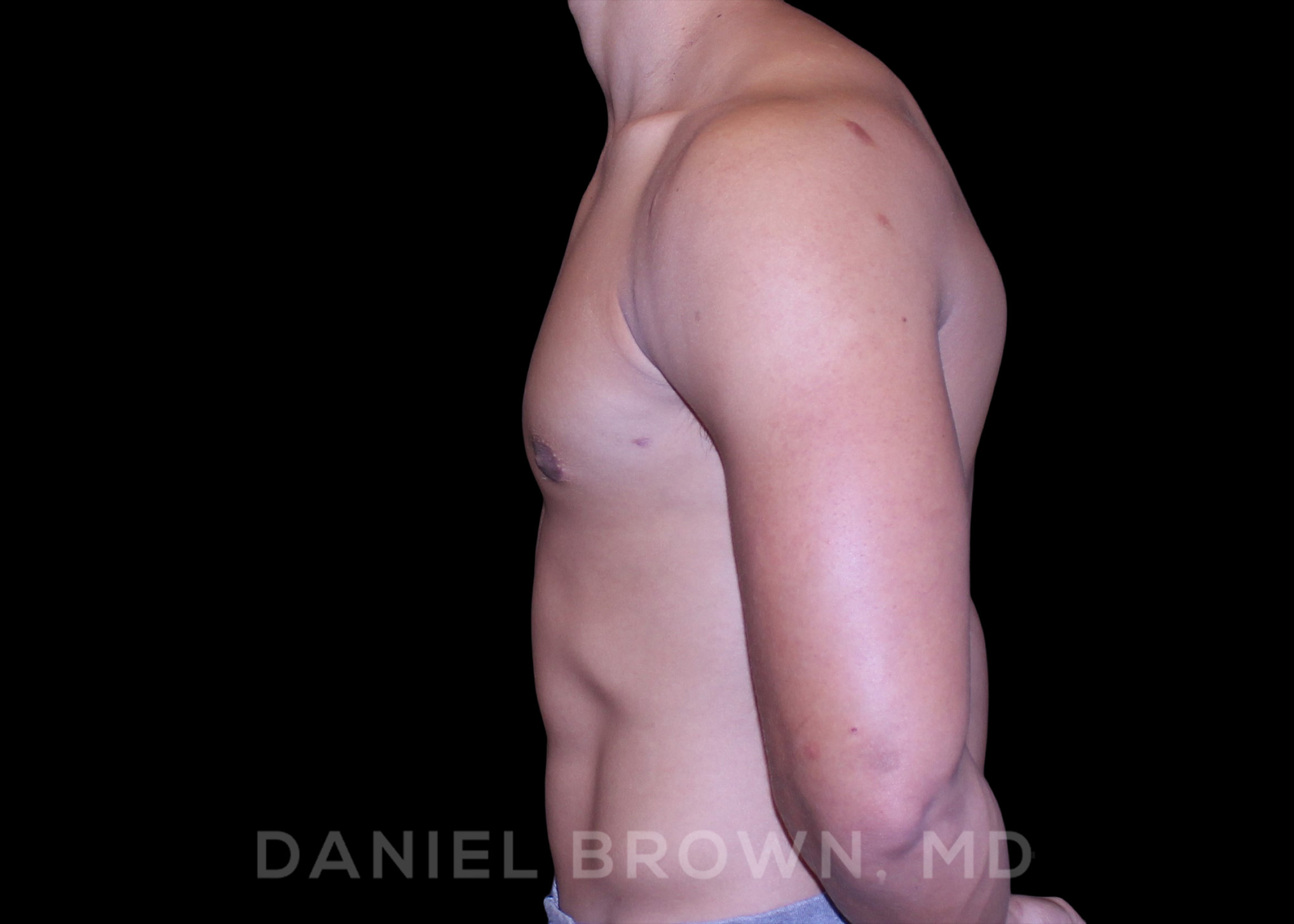 Male Breast Reduction Patient Photo - Case 2669 - after view-3