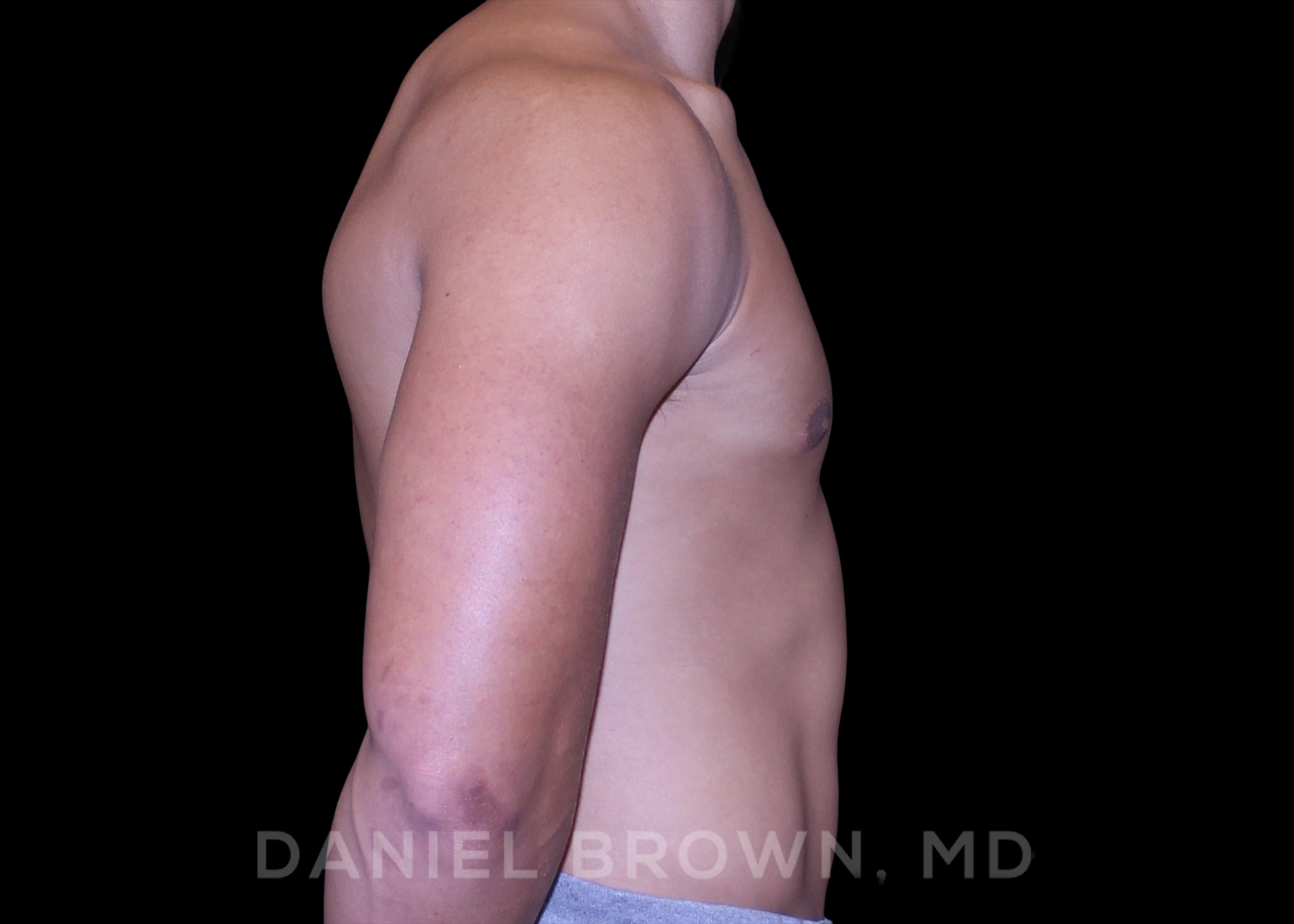 Male Breast Reduction Patient Photo - Case 2669 - after view-4