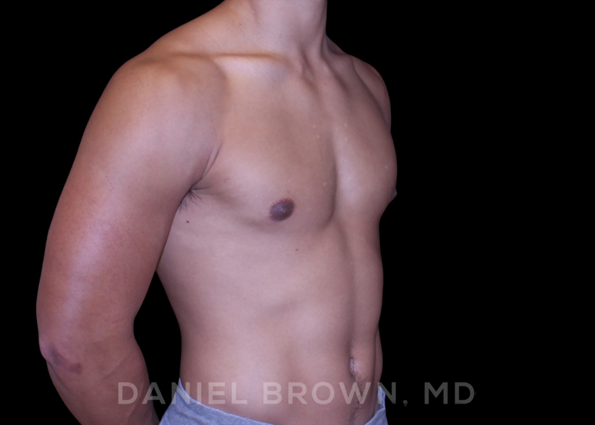 Male Breast Reduction Patient Photo - Case 2669 - after view-2