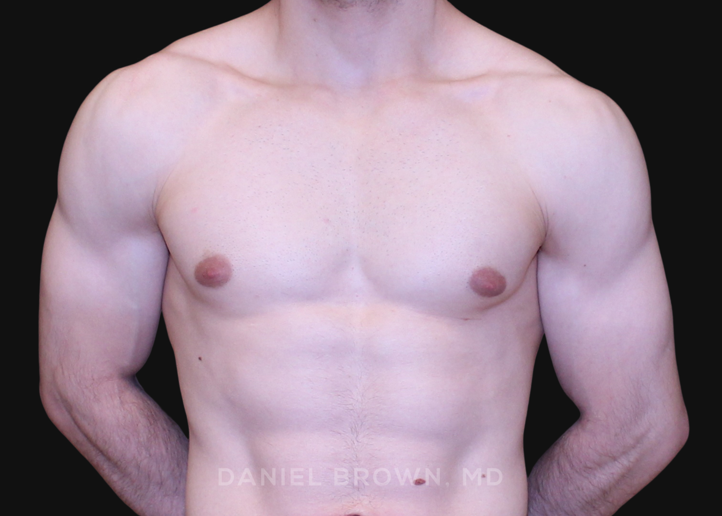 Male Breast Reduction Patient Photo - Case 2691 - after view-0