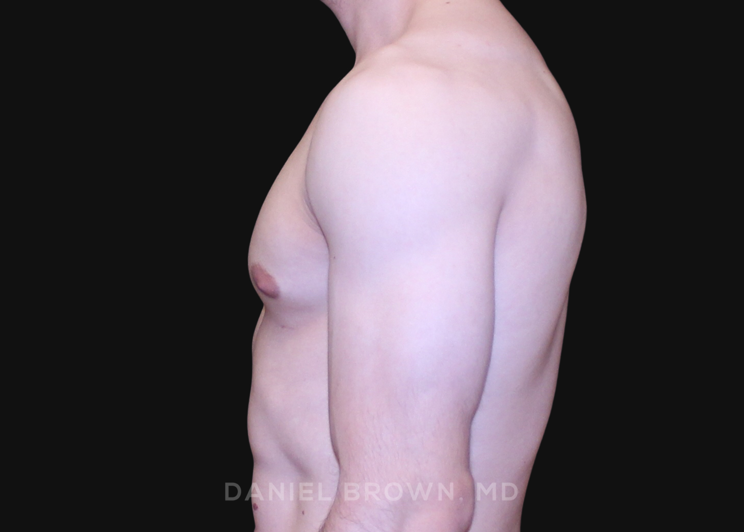 Male Breast Reduction Patient Photo - Case 2691 - after view-3
