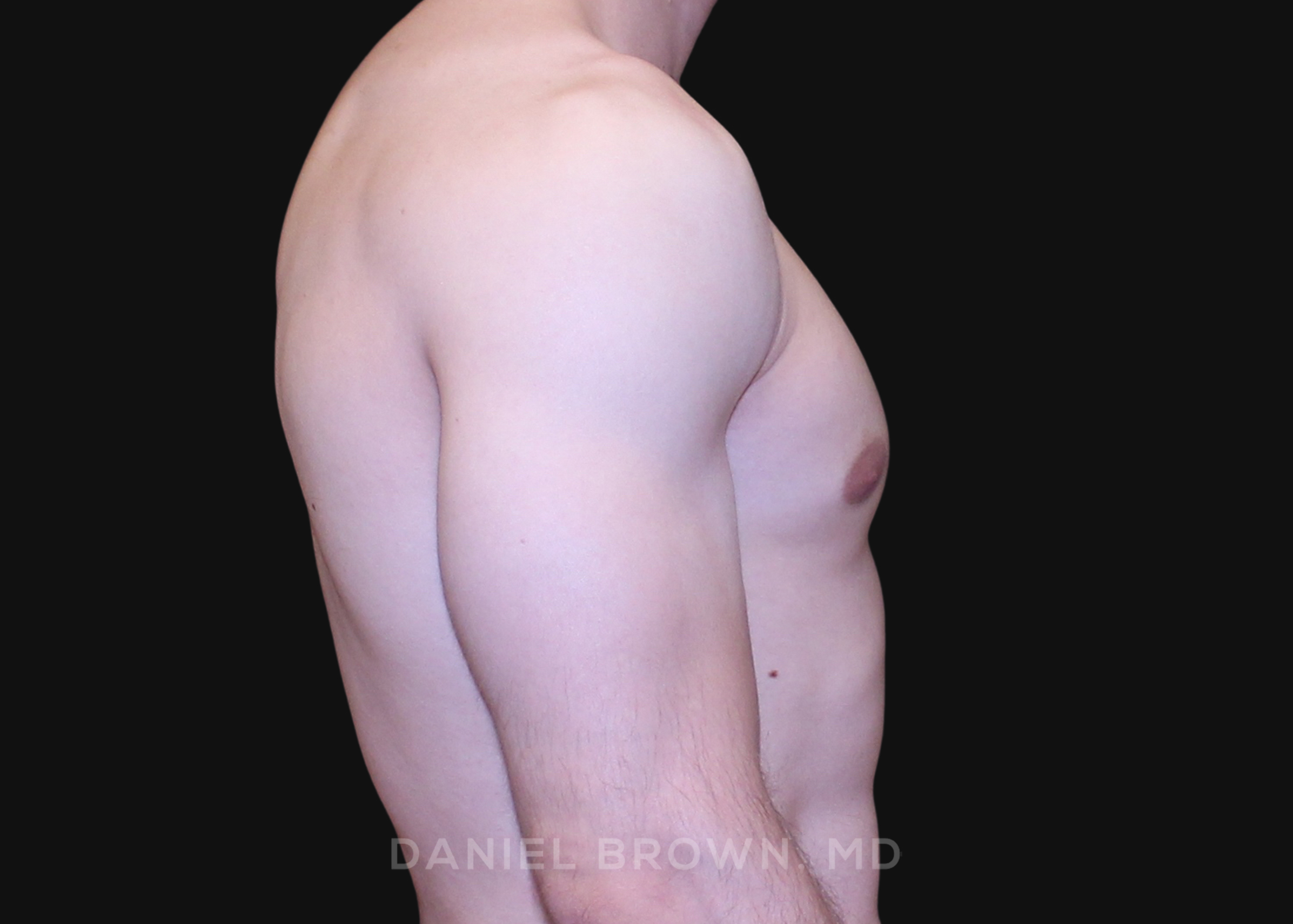 Male Breast Reduction Patient Photo - Case 2691 - after view-4