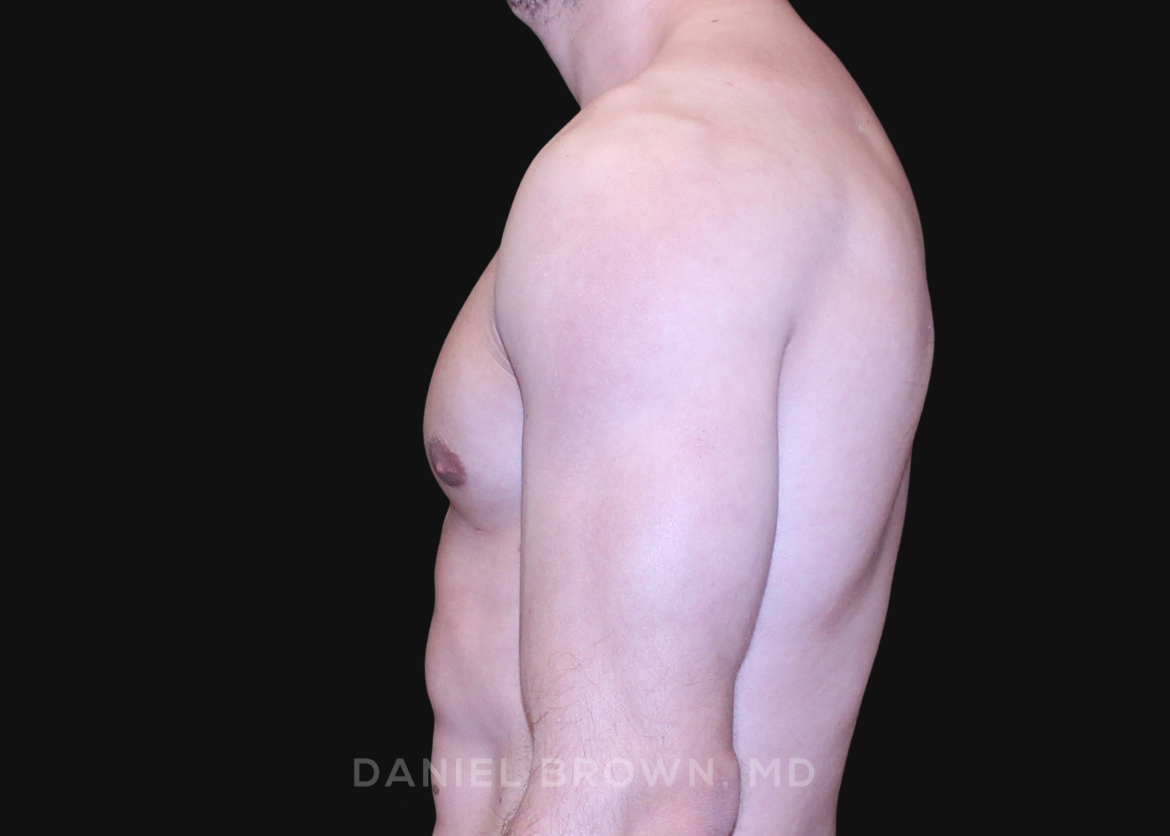 Male Breast Reduction Patient Photo - Case 2691 - before view-