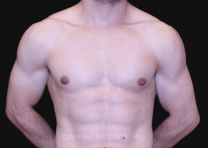 Male Breast Reduction - Case 2691 - Before