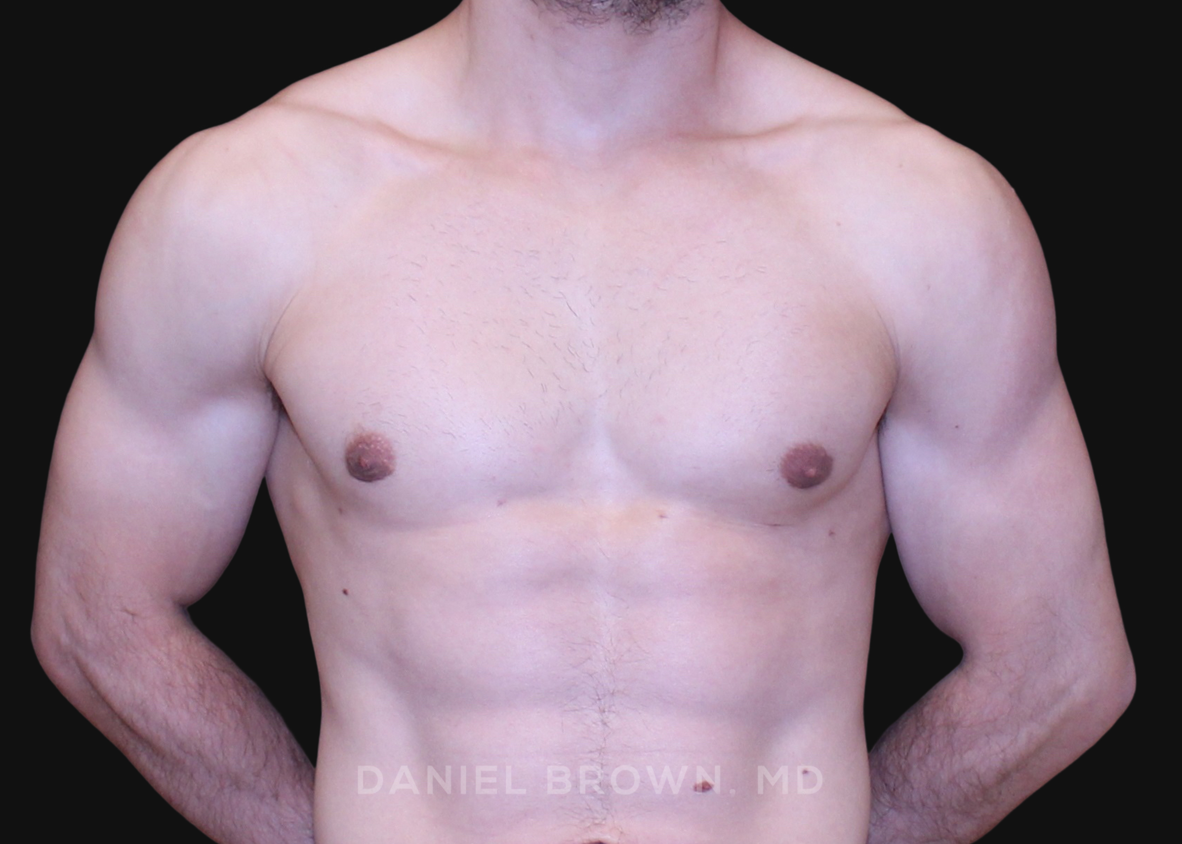 Male Breast Reduction Patient Photo - Case 2691 - before view-