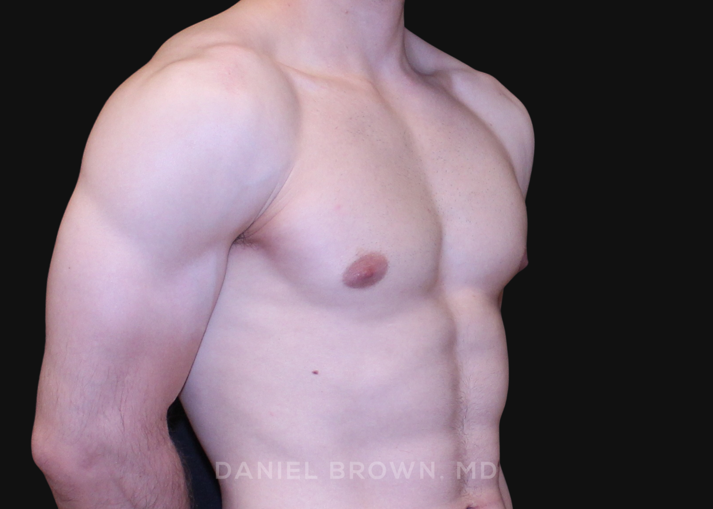 Male Breast Reduction Patient Photo - Case 2691 - after view-2