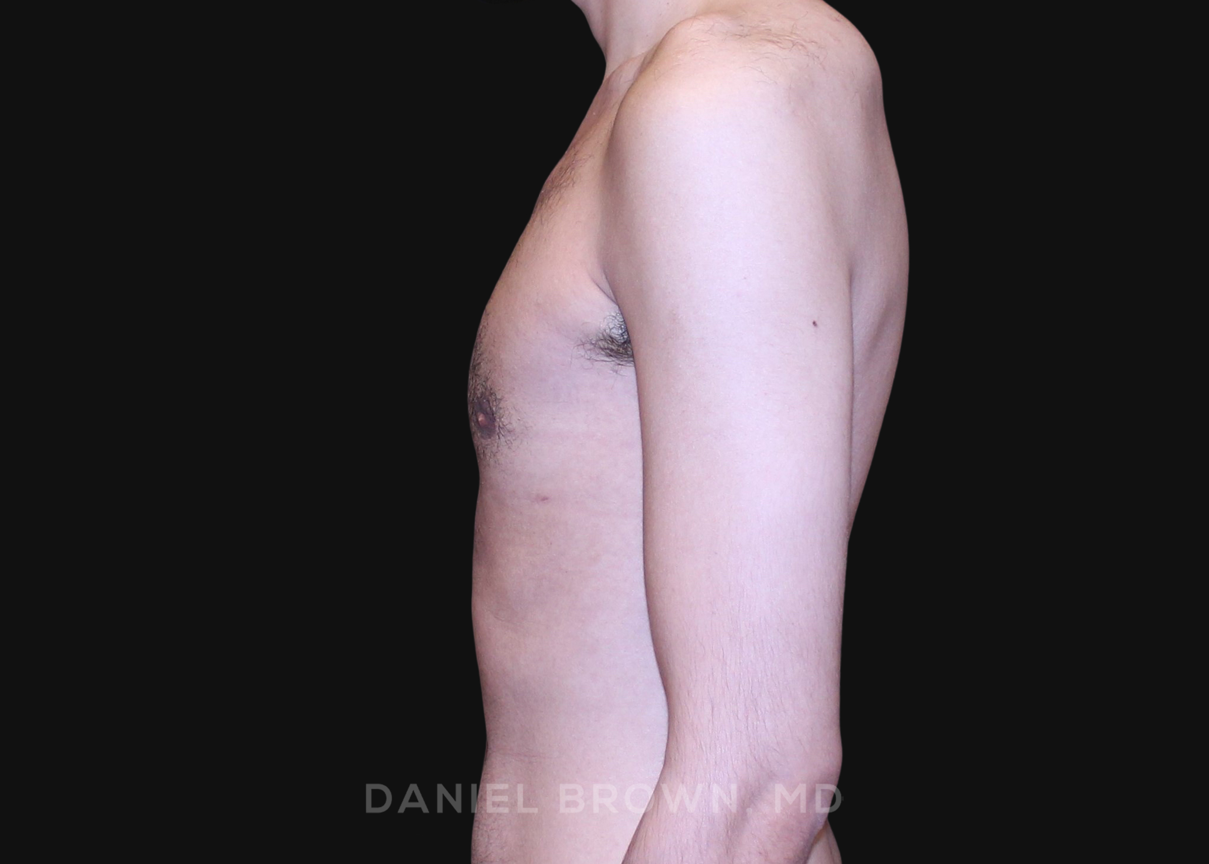 Male Breast Reduction Patient Photo - Case 2702 - after view