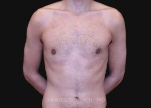 Male Breast Reduction - Case 2702 - After