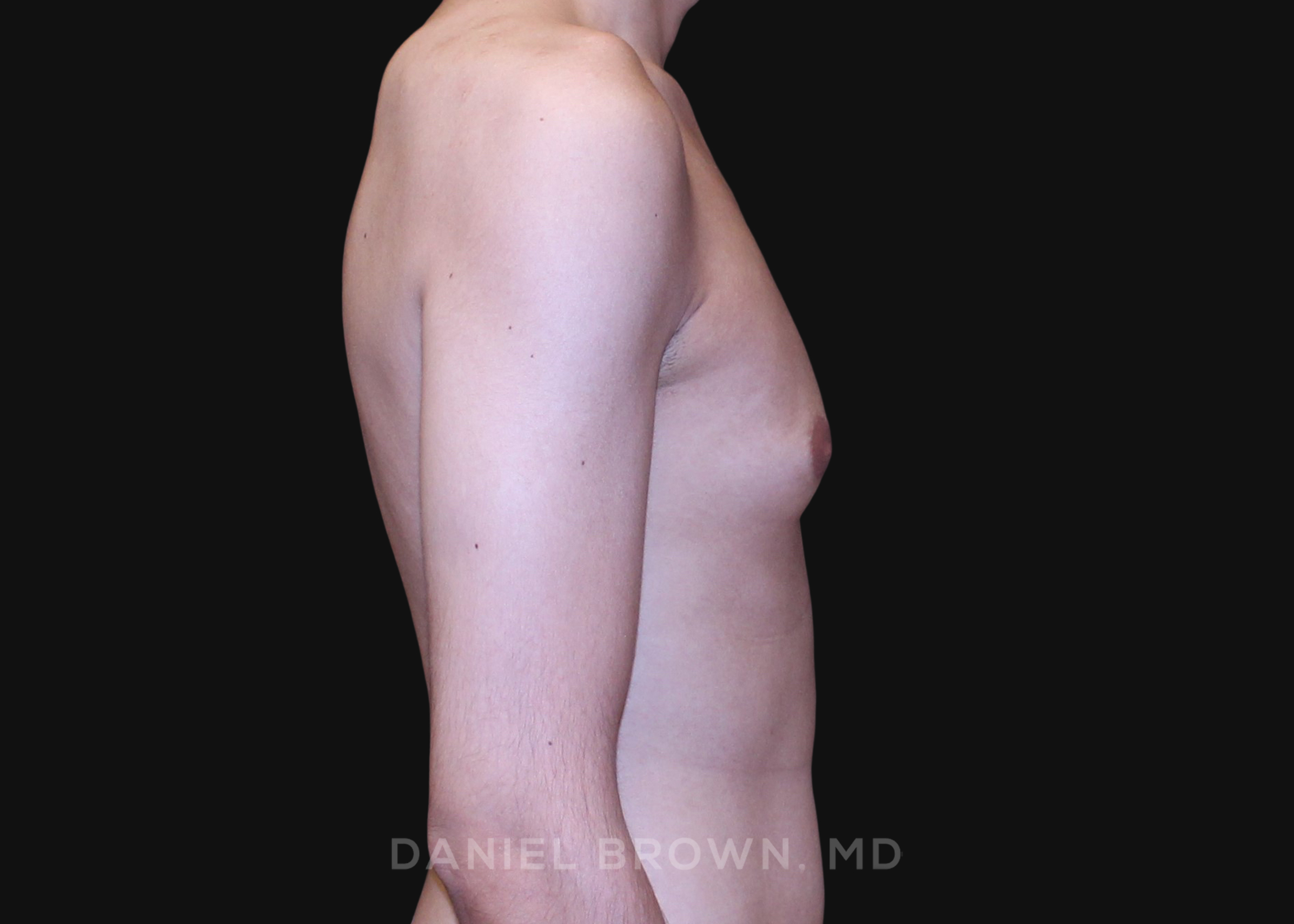 Male Breast Reduction Patient Photo - Case 2702 - before view-4