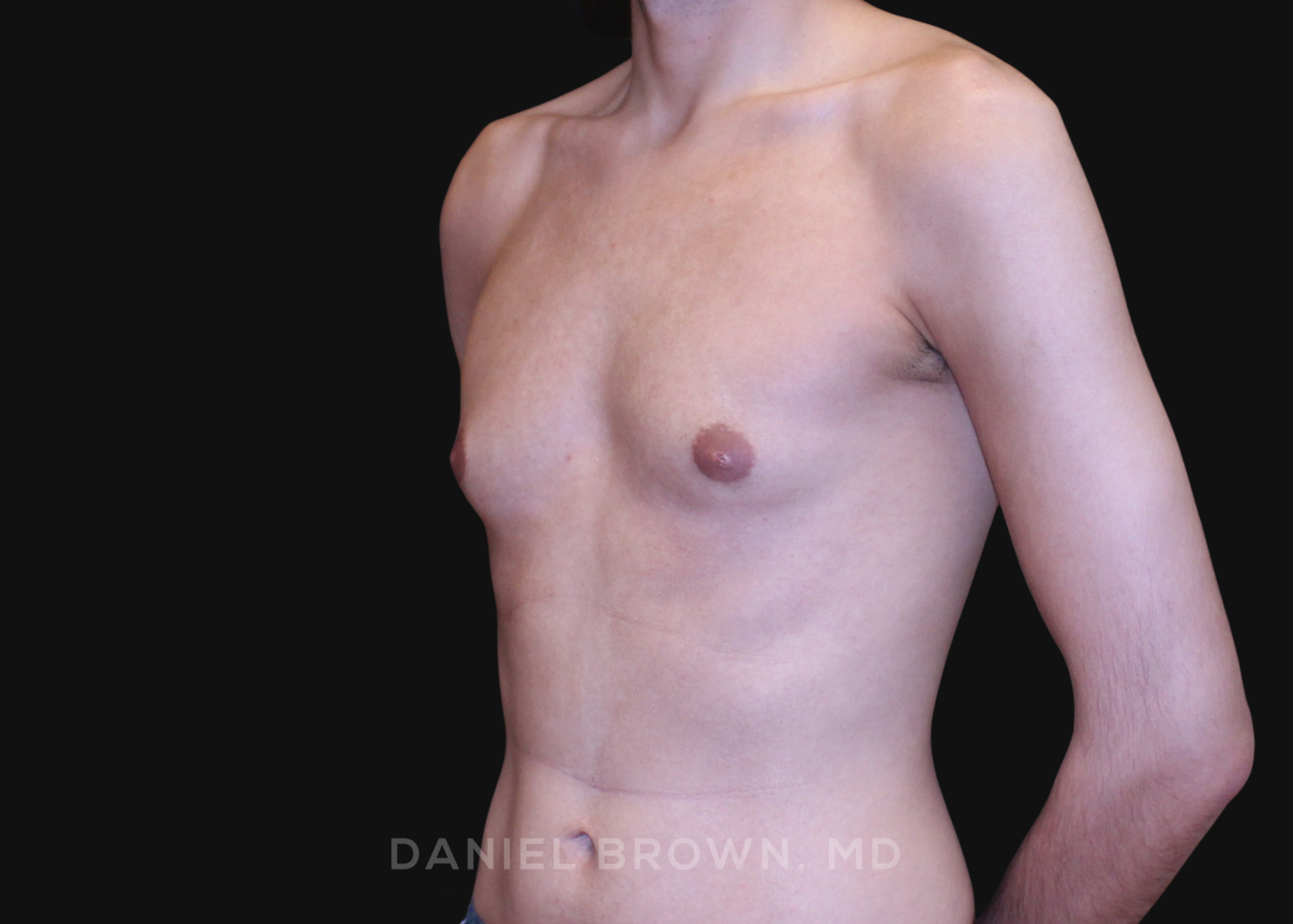Male Breast Reduction Patient Photo - Case 2702 - before view-1