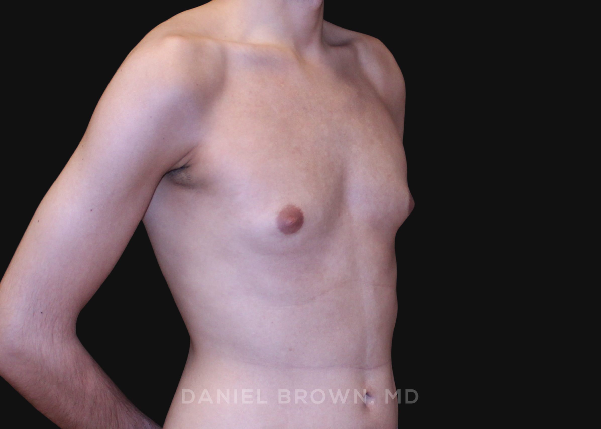 Male Breast Reduction Patient Photo - Case 2702 - before view-2