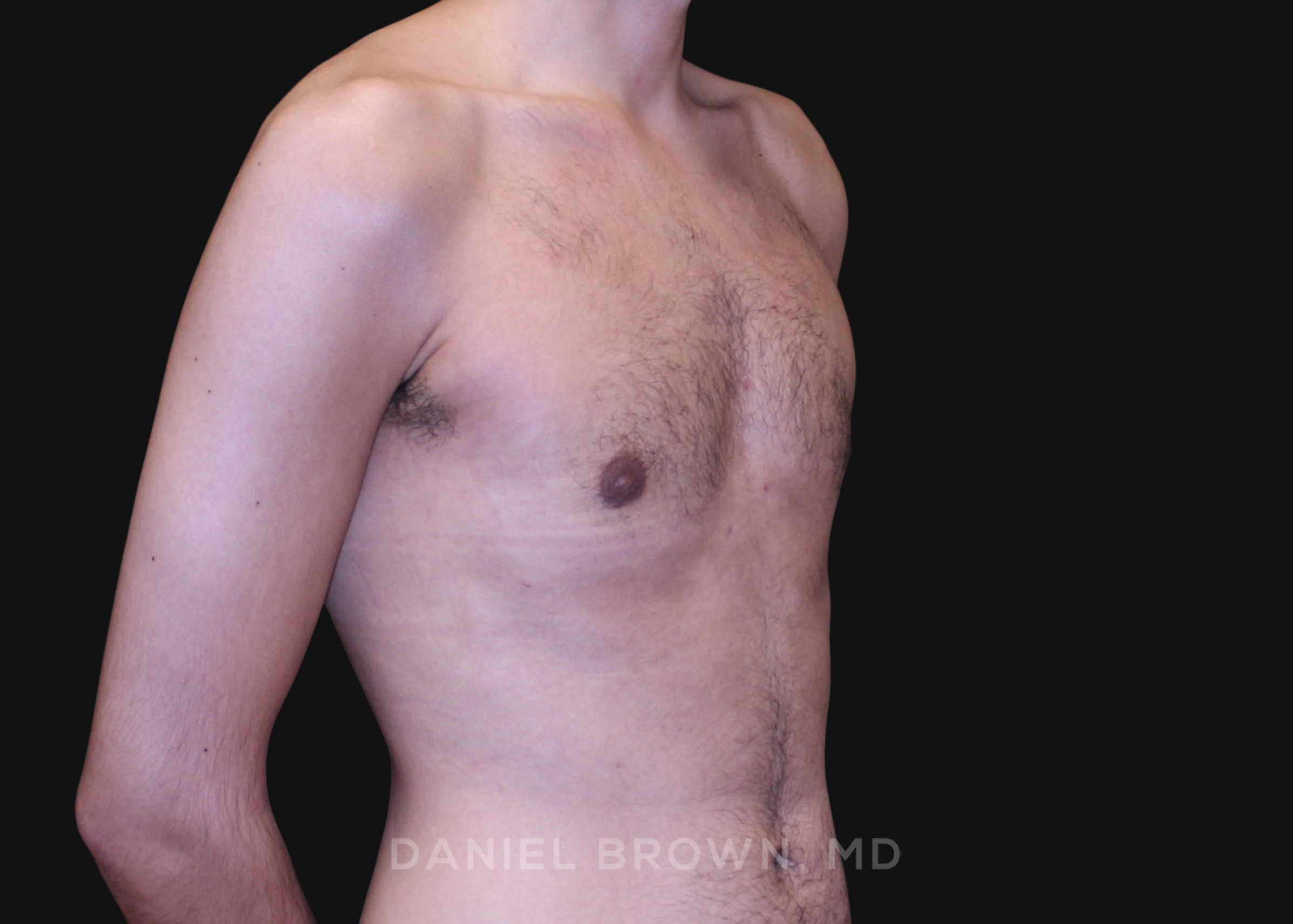 Male Breast Reduction Patient Photo - Case 2702 - after view
