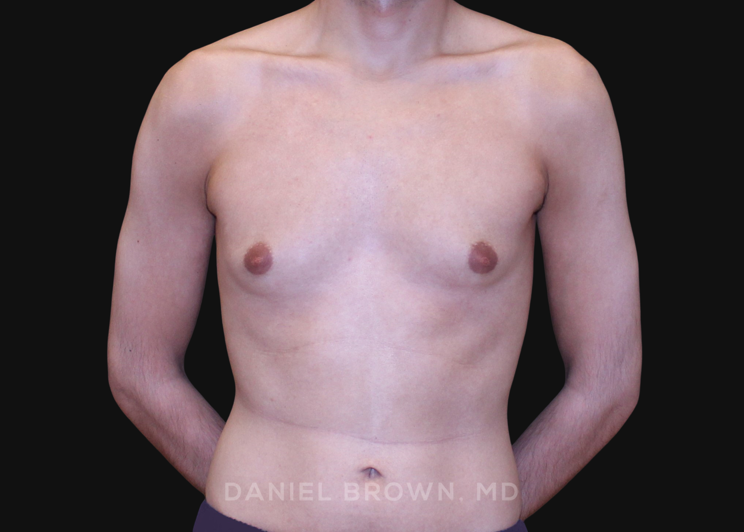 Male Breast Reduction Patient Photo - Case 2702 - before view-0