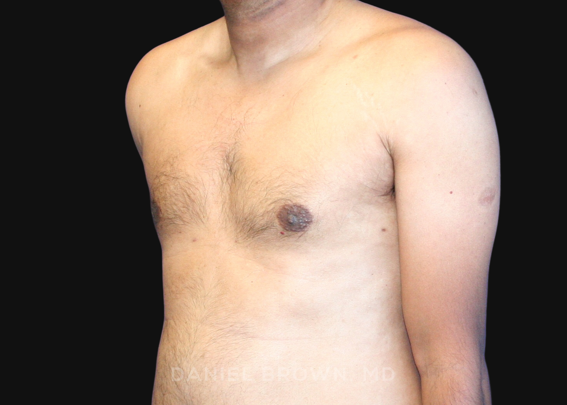 Male Breast Reduction Patient Photo - Case 2713 - after view-1