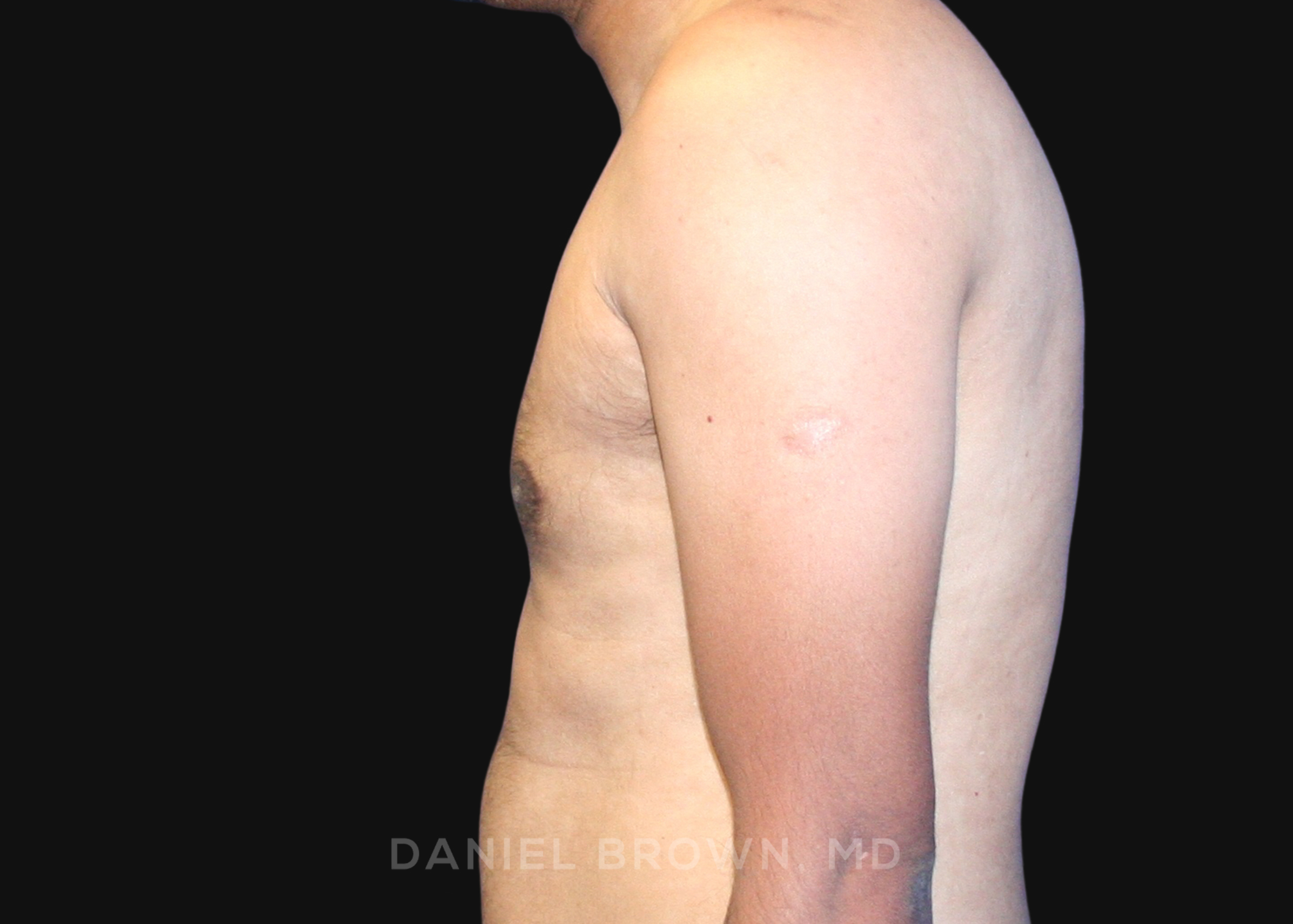 Male Breast Reduction Patient Photo - Case 2713 - after view-3