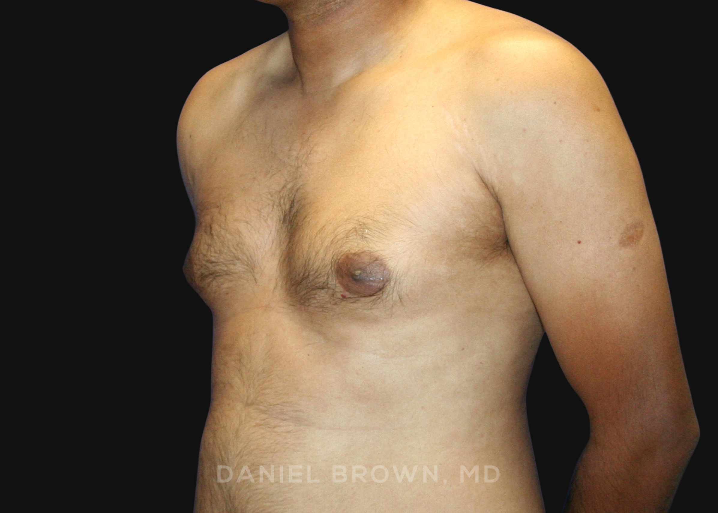 Male Breast Reduction Patient Photo - Case 2713 - before view-1