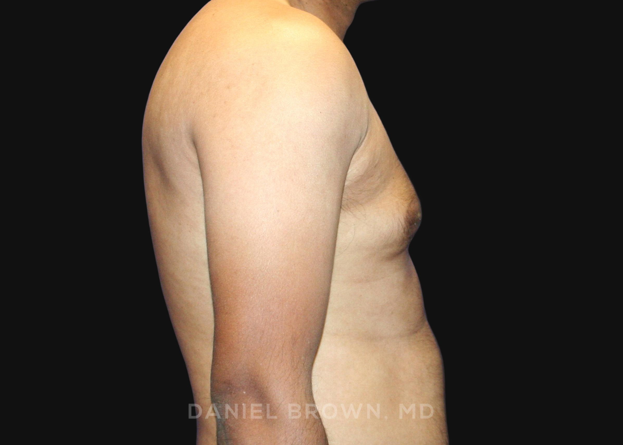 Male Breast Reduction Patient Photo - Case 2713 - before view-4