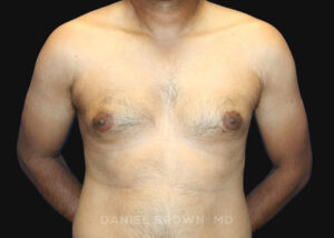 Male Breast Reduction - Case 2713 - Before