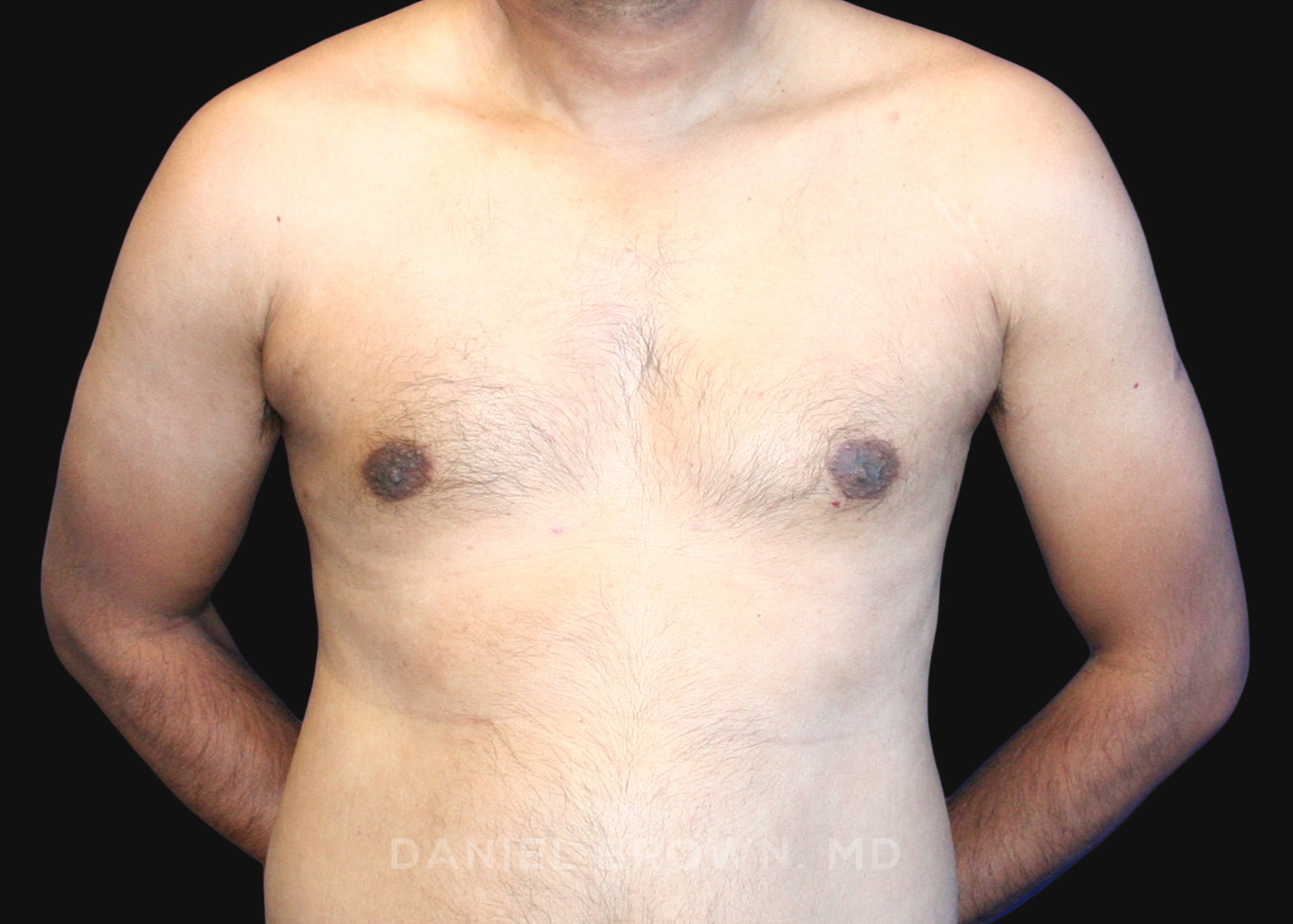Male Breast Reduction Patient Photo - Case 2713 - after view