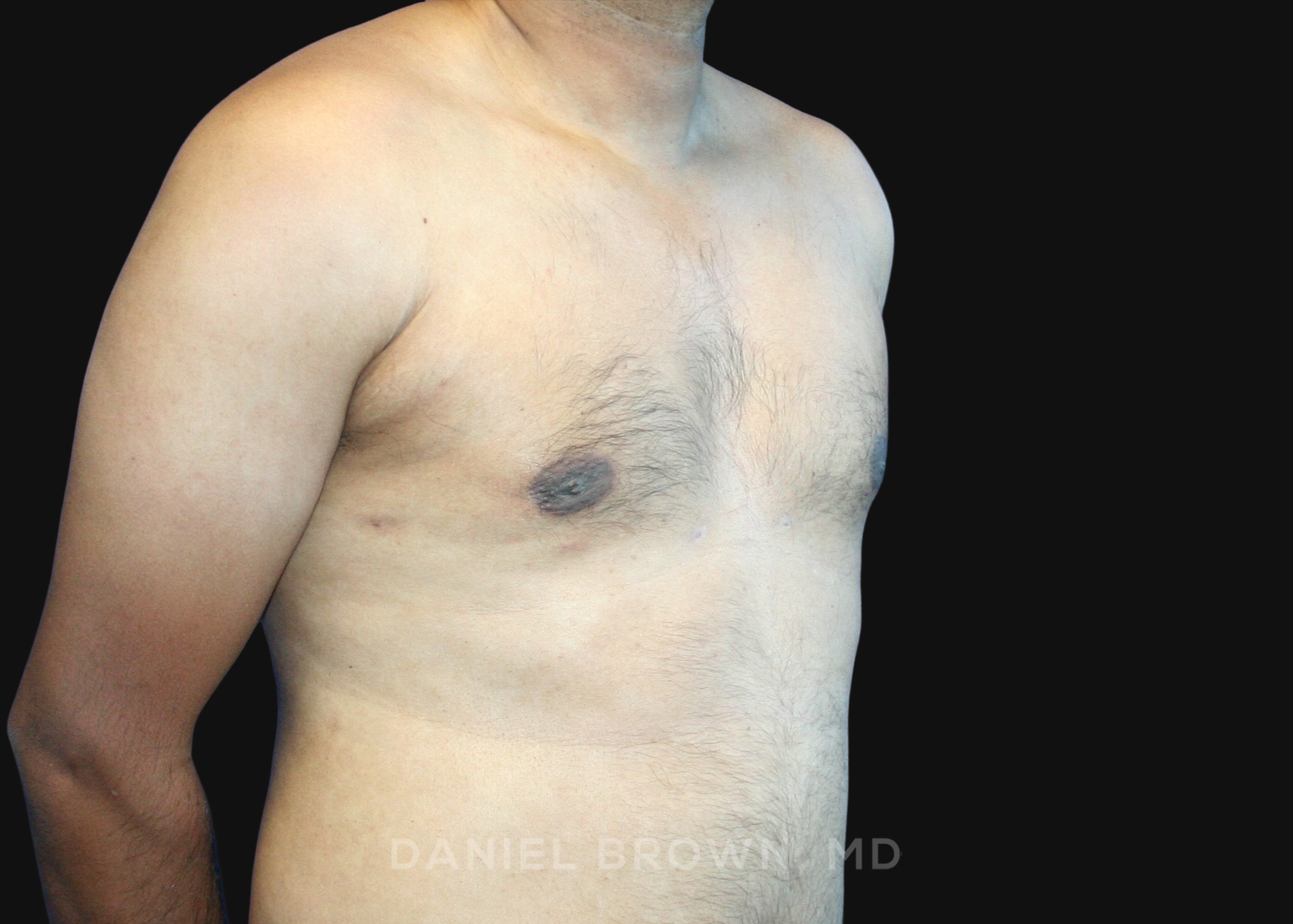 Male Breast Reduction Patient Photo - Case 2713 - after view