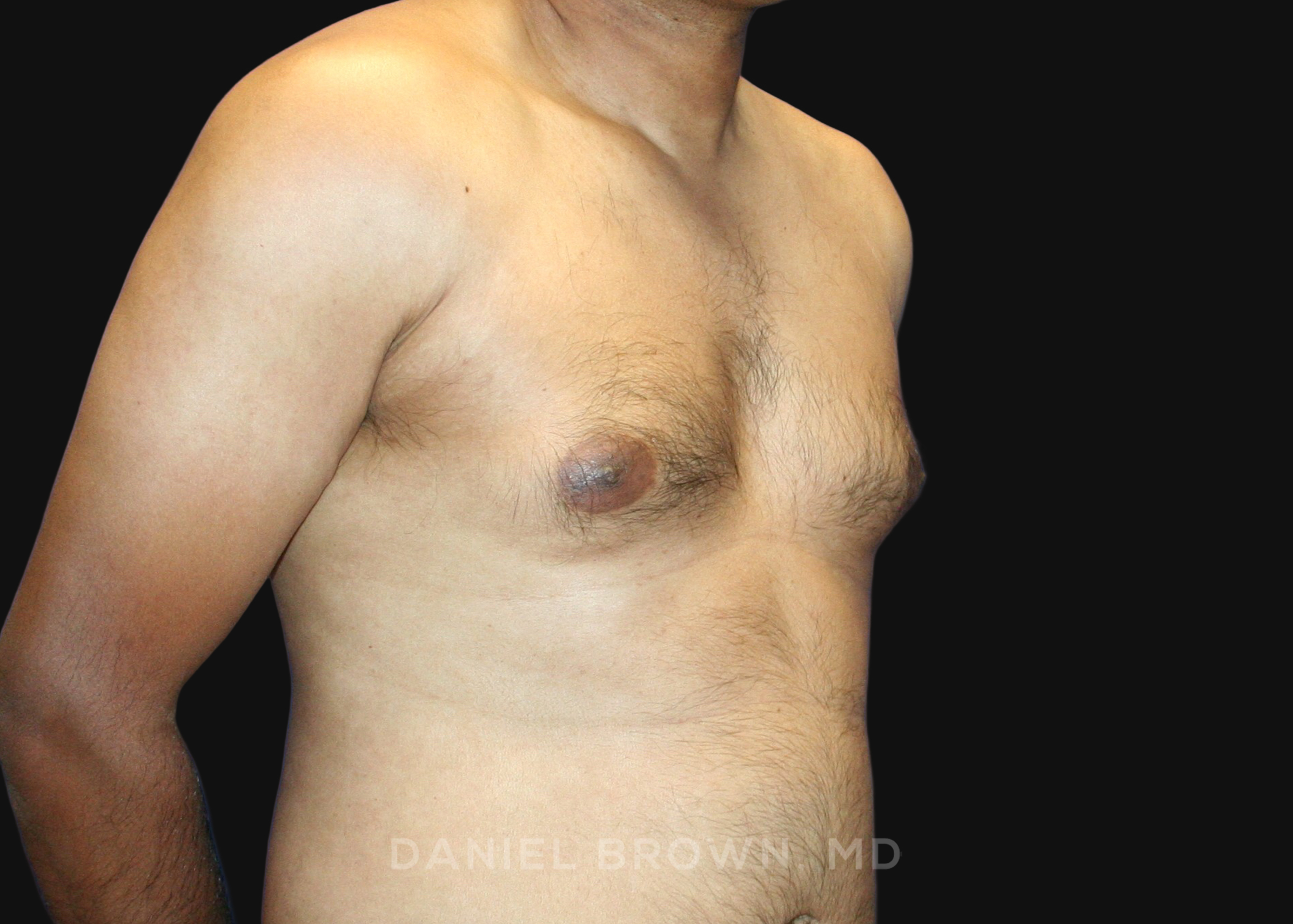 Male Breast Reduction Patient Photo - Case 2713 - before view-2