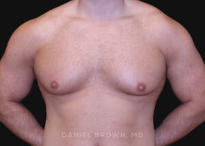 Male Breast Reduction - Case 2724 - Before