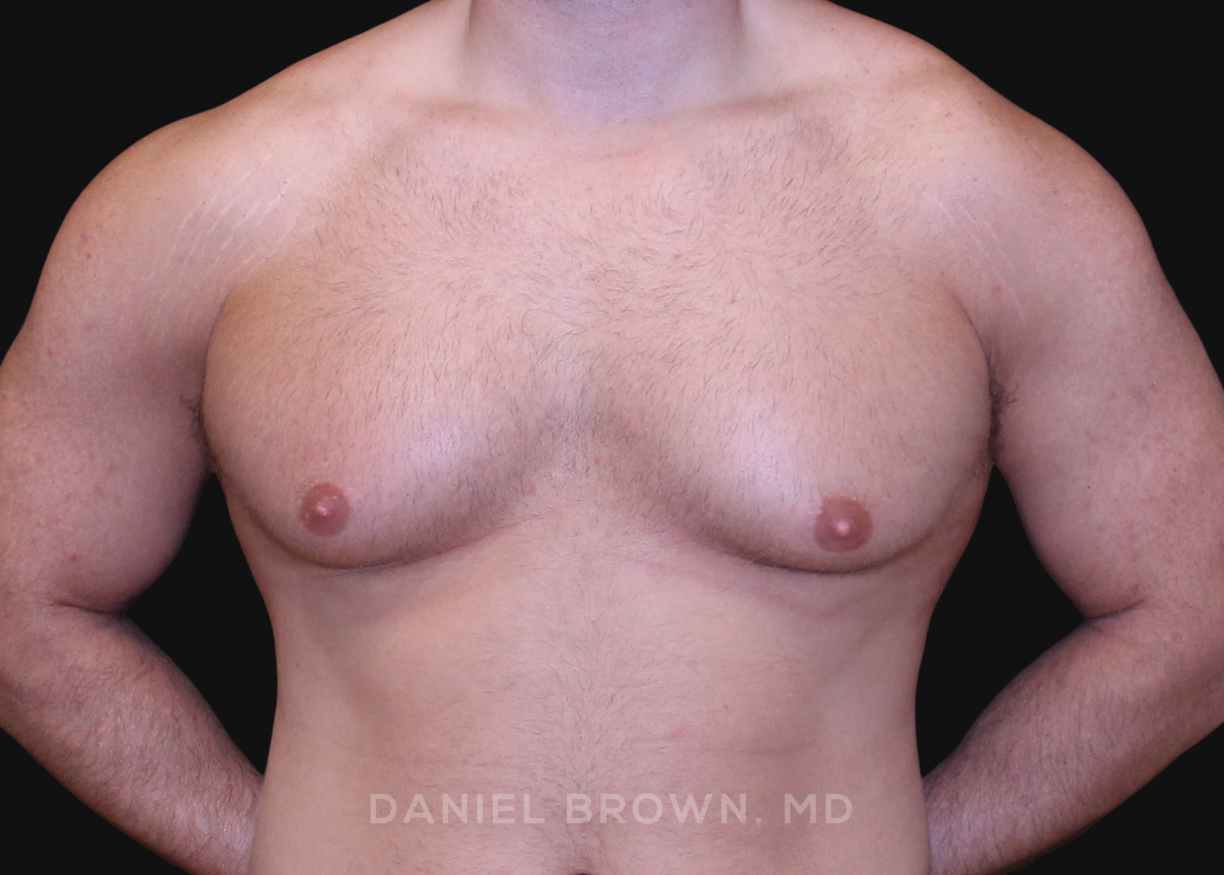 Male Breast Reduction Patient Photo - Case 2724 - before view-0