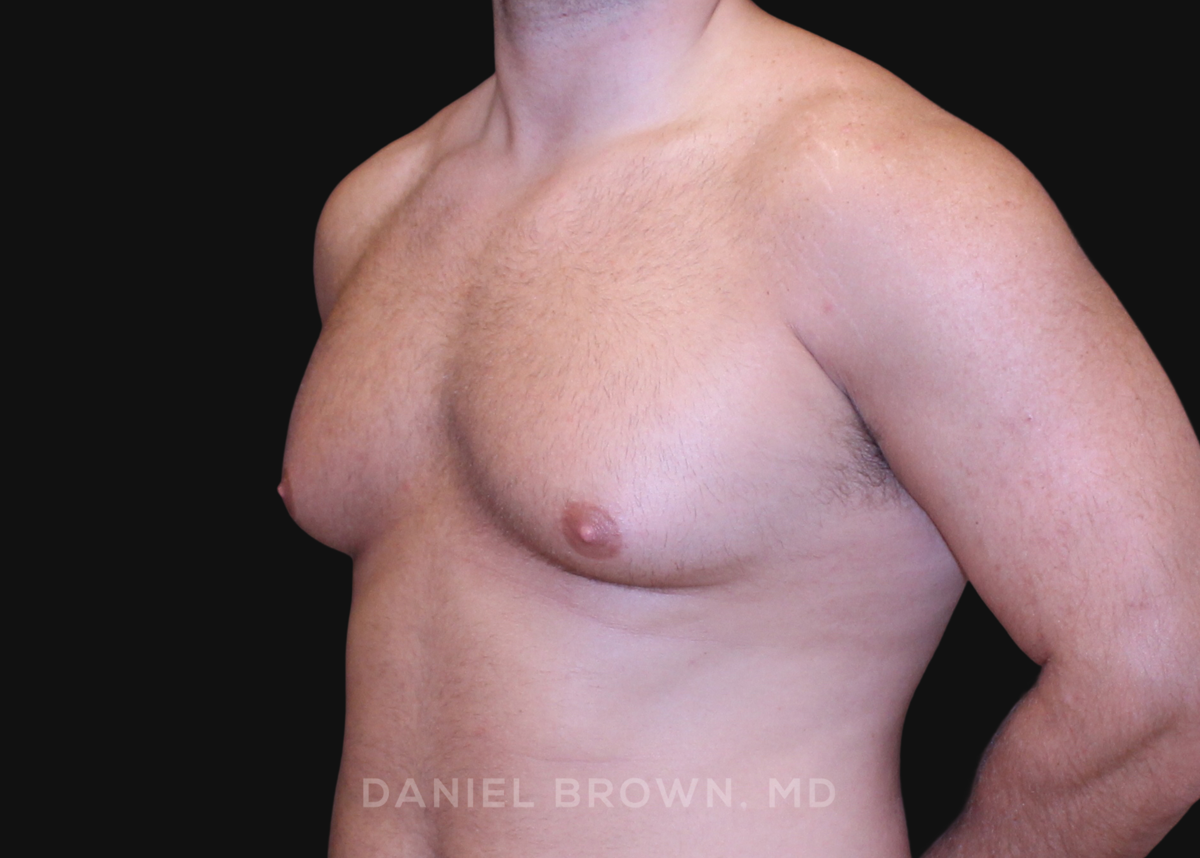 Male Breast Reduction Patient Photo - Case 2724 - before view-