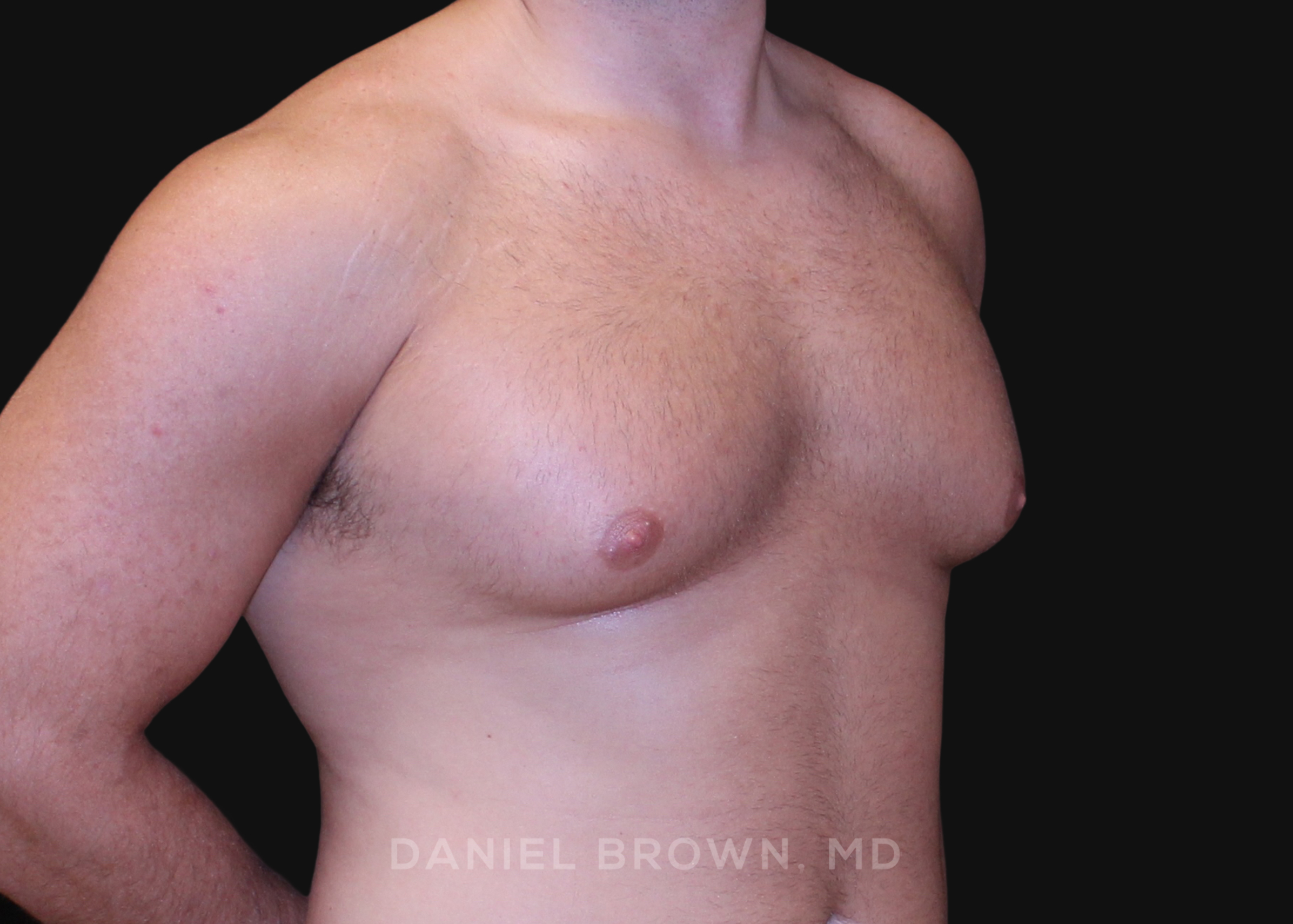 Male Breast Reduction Patient Photo - Case 2724 - before view-2