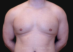 Male Breast Reduction - Case 2724 - After