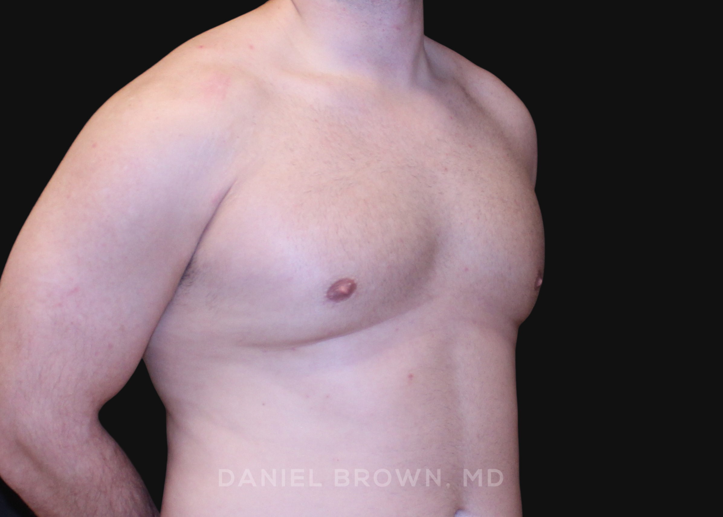 Male Breast Reduction Patient Photo - Case 2724 - after view