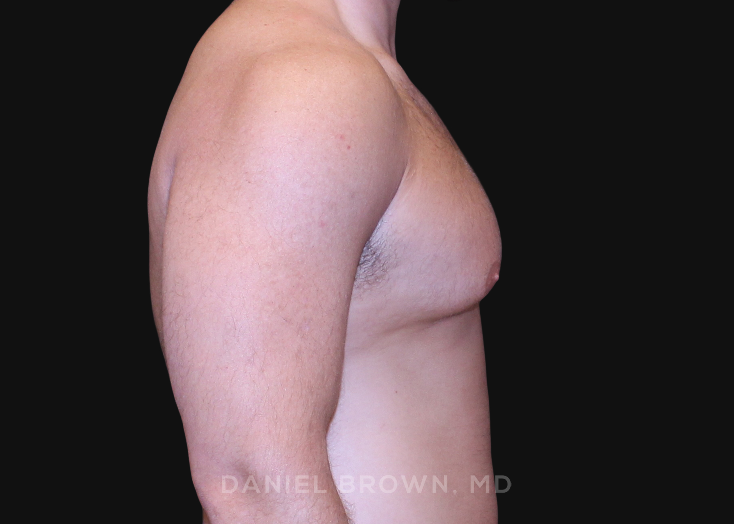Male Breast Reduction Patient Photo - Case 2724 - before view-4