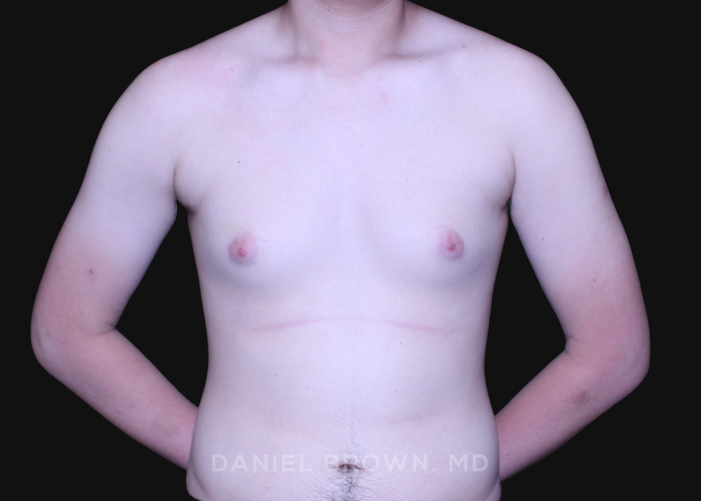 Male Breast Reduction Patient Photo - Case 2735 - before view-