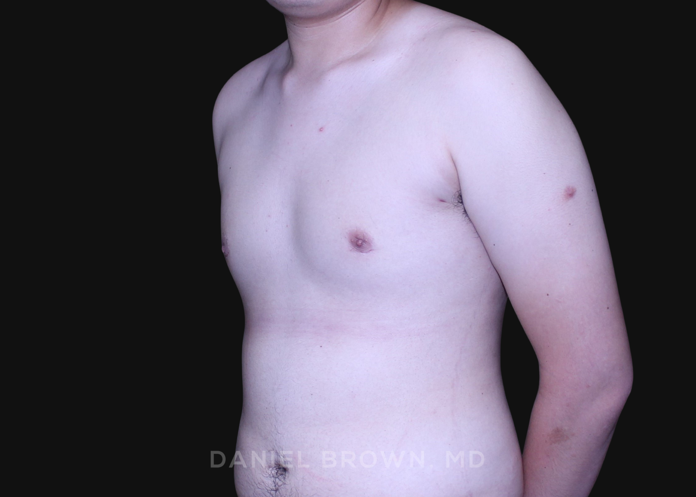 Male Breast Reduction Patient Photo - Case 2735 - before view-2