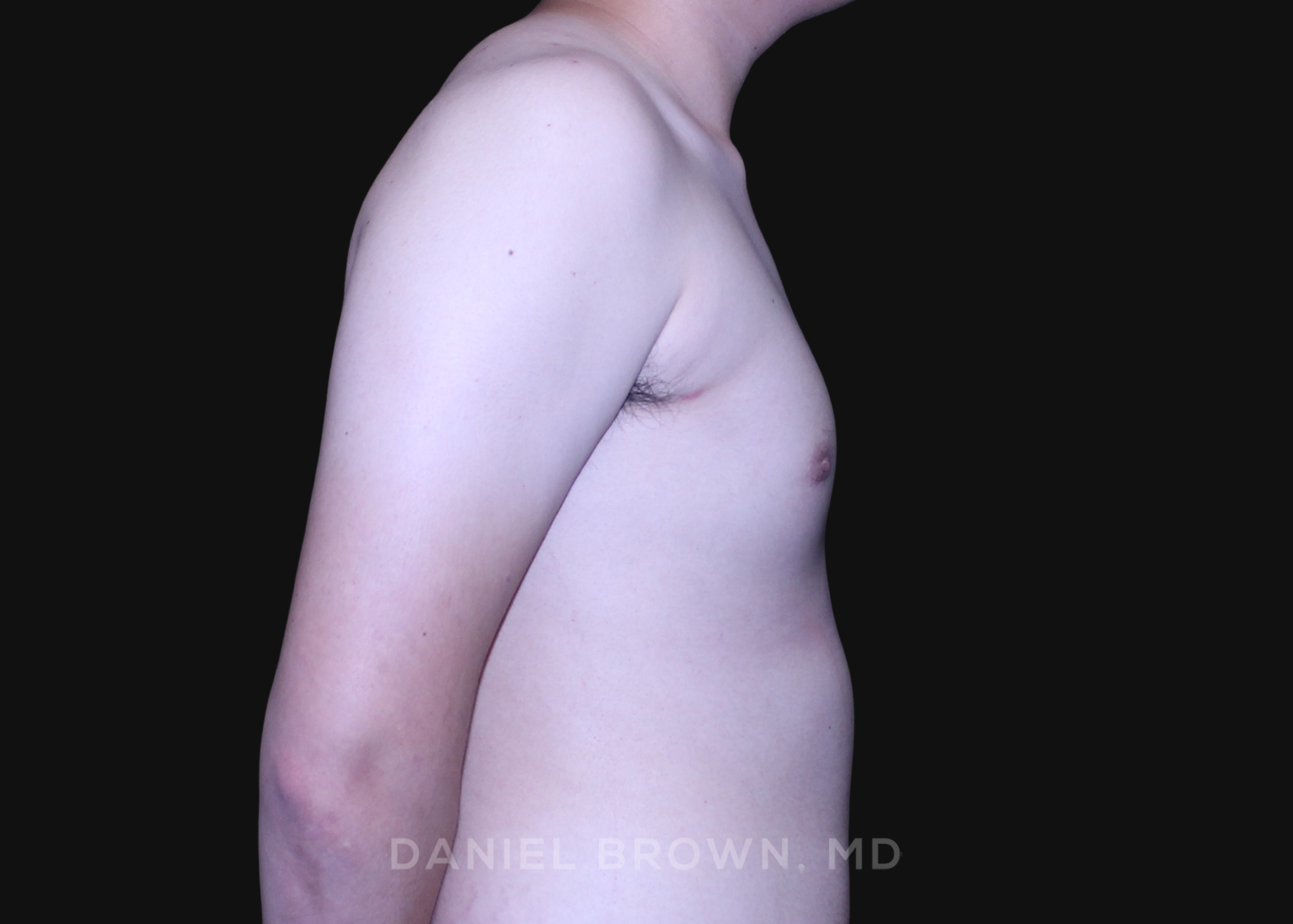 Male Breast Reduction Patient Photo - Case 2735 - after view-6