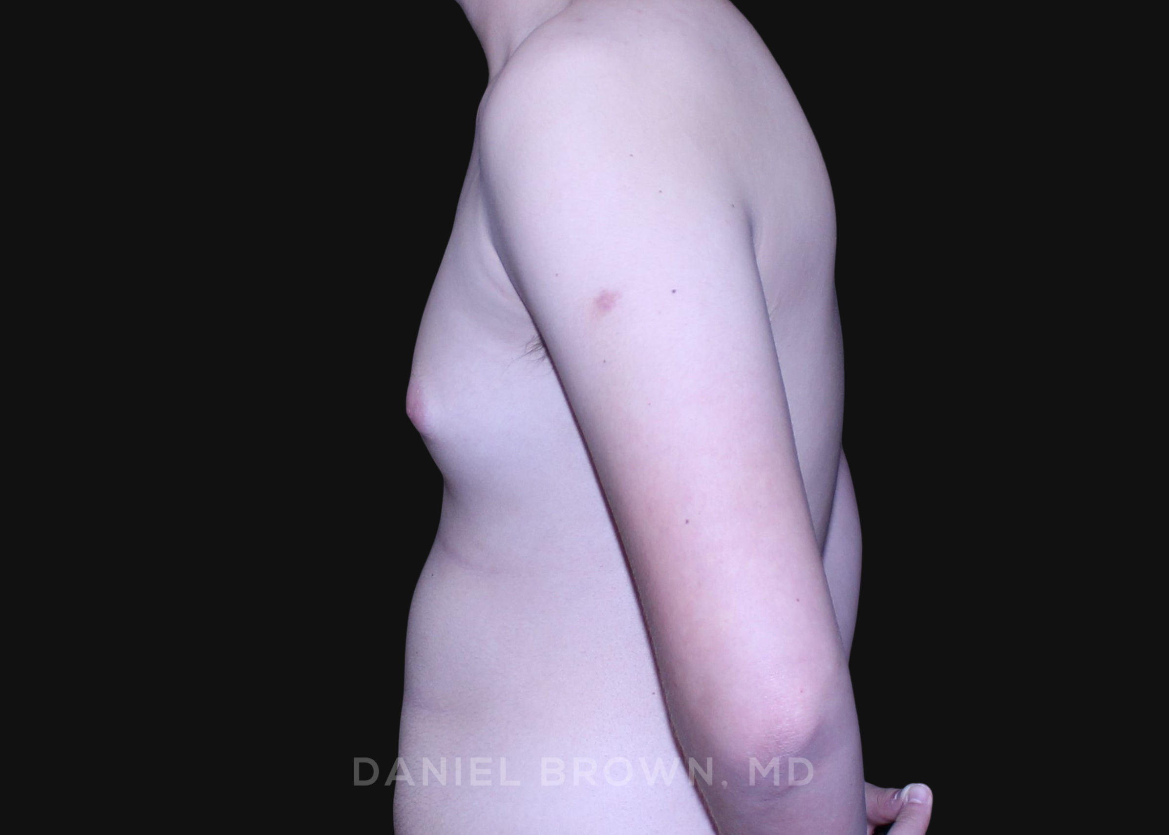 Male Breast Reduction Patient Photo - Case 2735 - after view-4