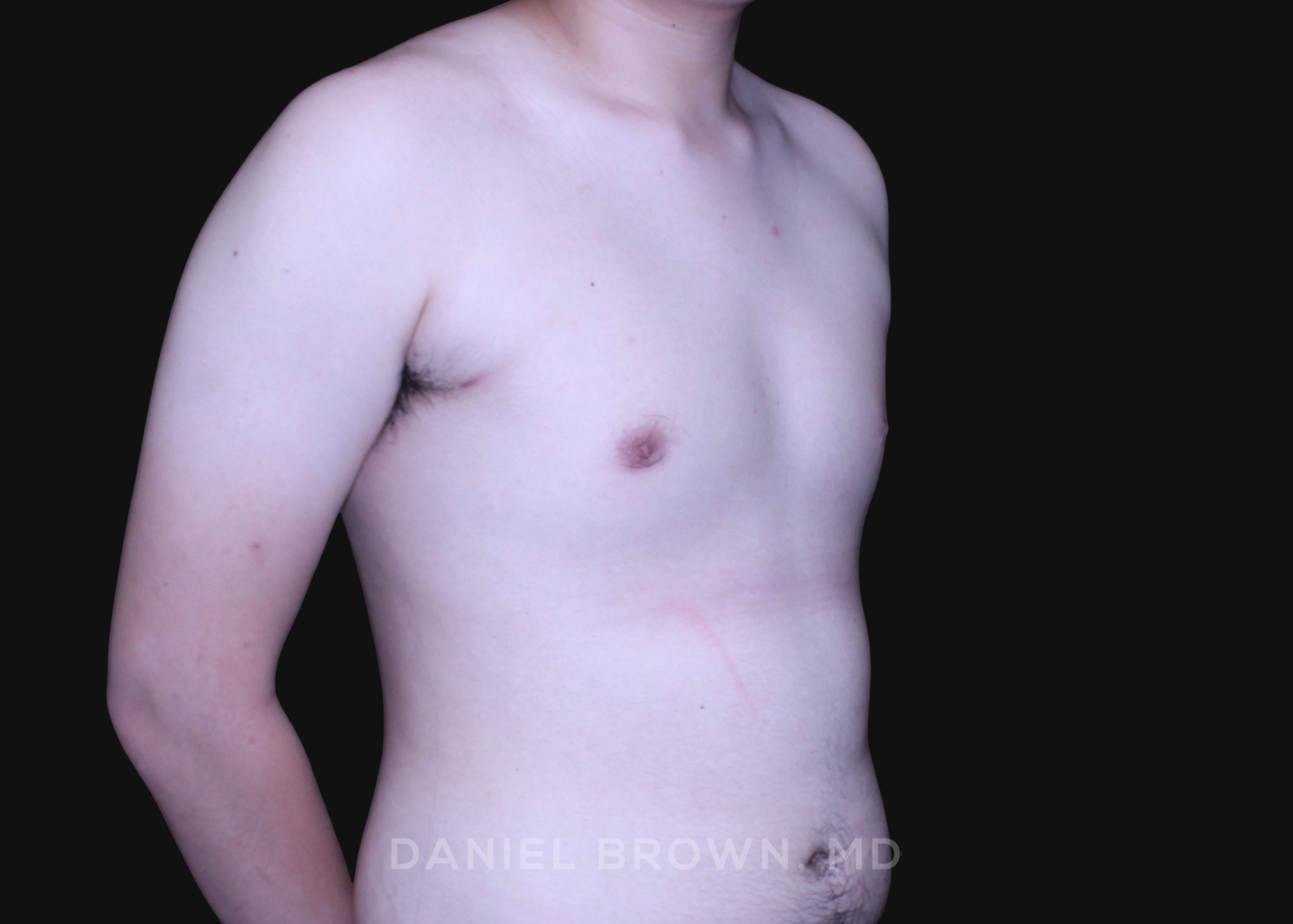 Male Breast Reduction Patient Photo - Case 2735 - before view-4