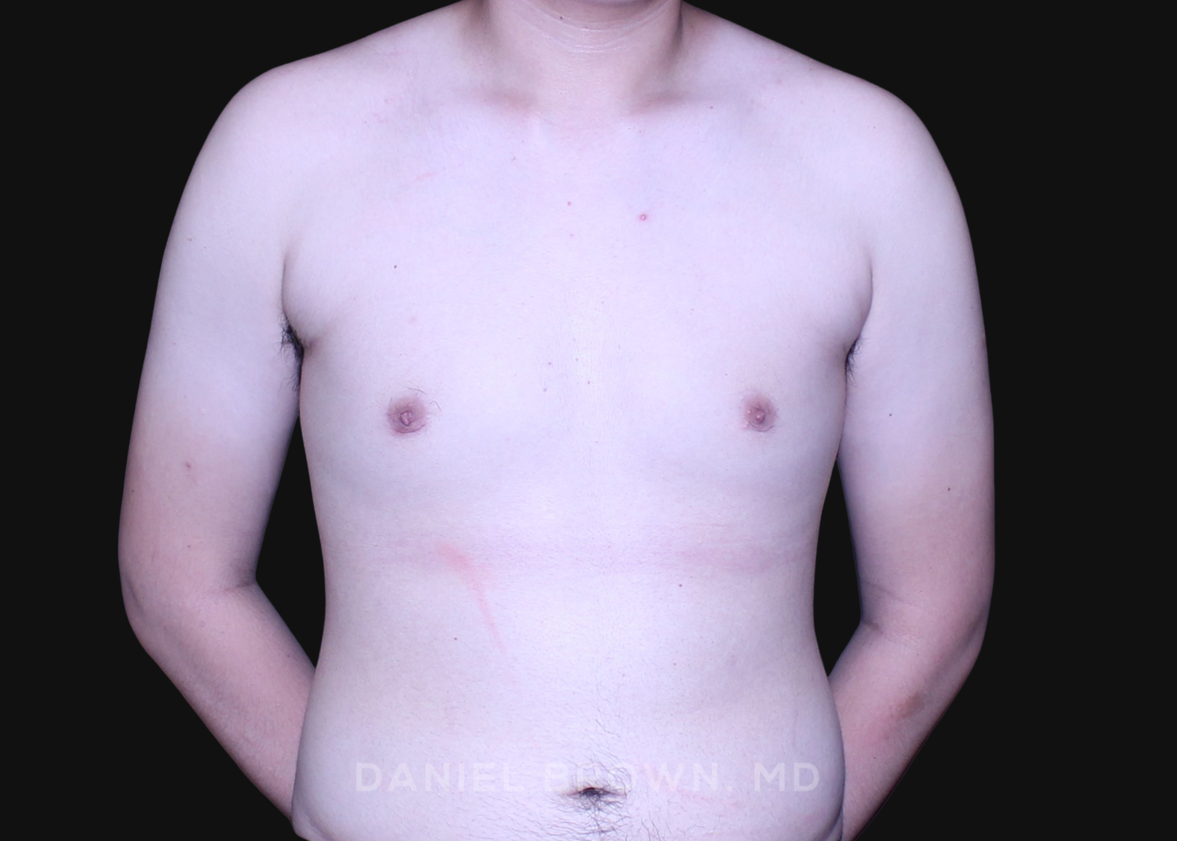 Male Breast Reduction Patient Photo - Case 2735 - before view-1