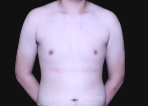 Male Breast Reduction - Case 2735 - After