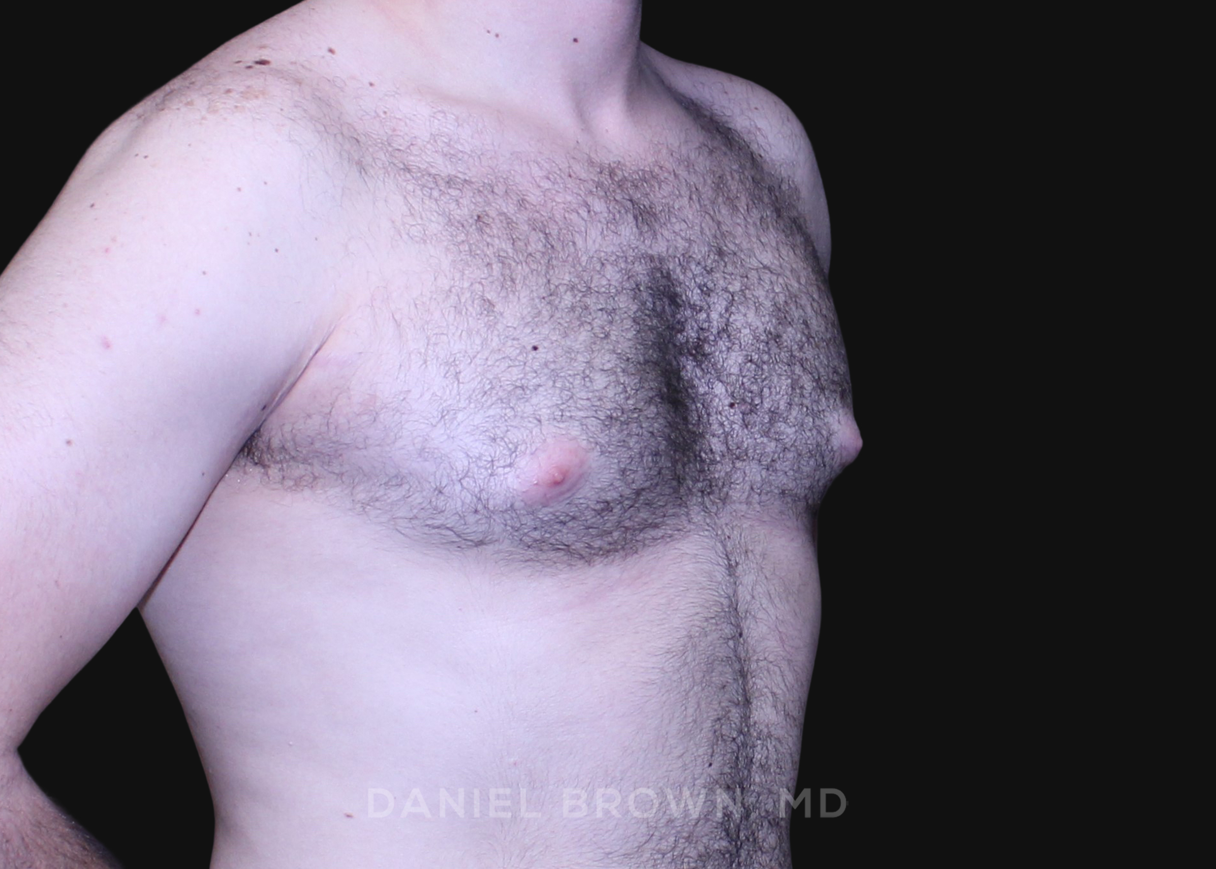 Male Breast Reduction Patient Photo - Case 2746 - before view-2