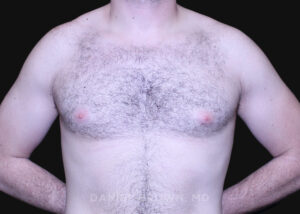 Male Breast Reduction - Case 2746 - Before