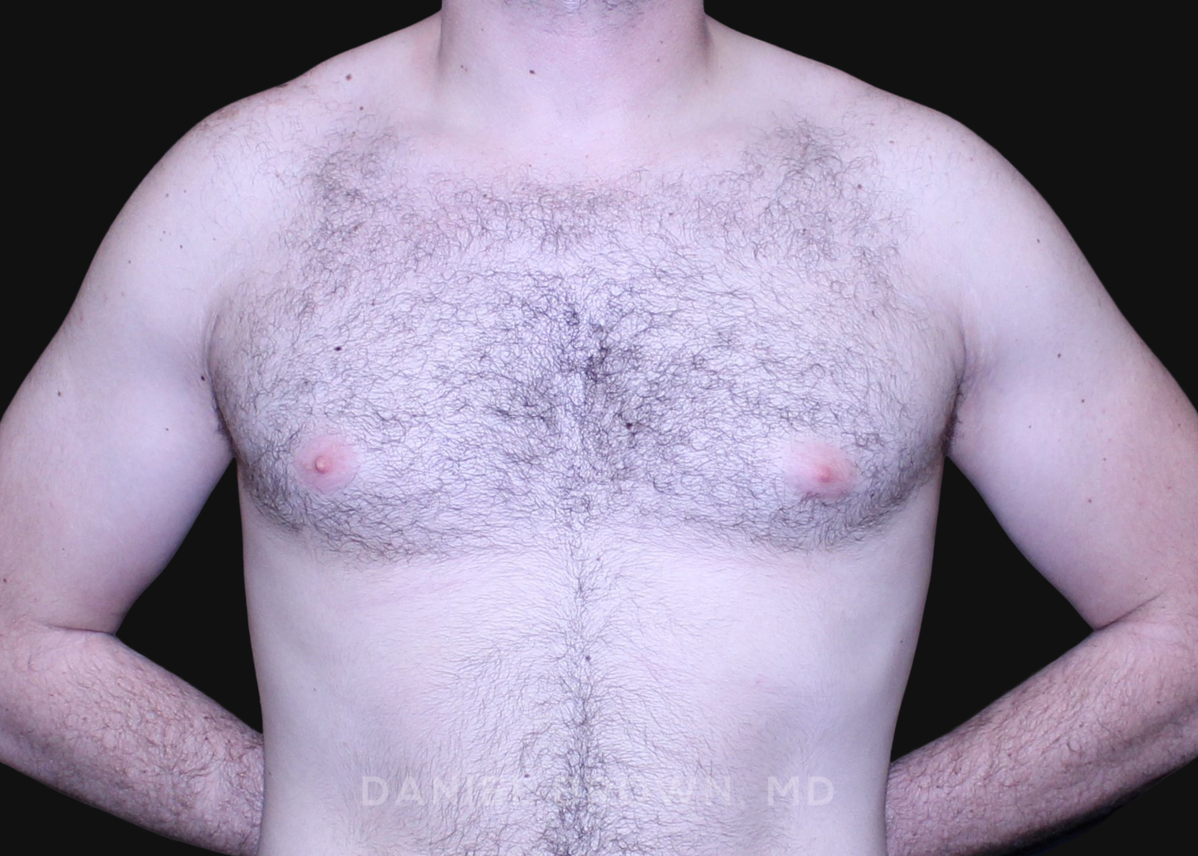 Male Breast Reduction Patient Photo - Case 2746 - before view-0